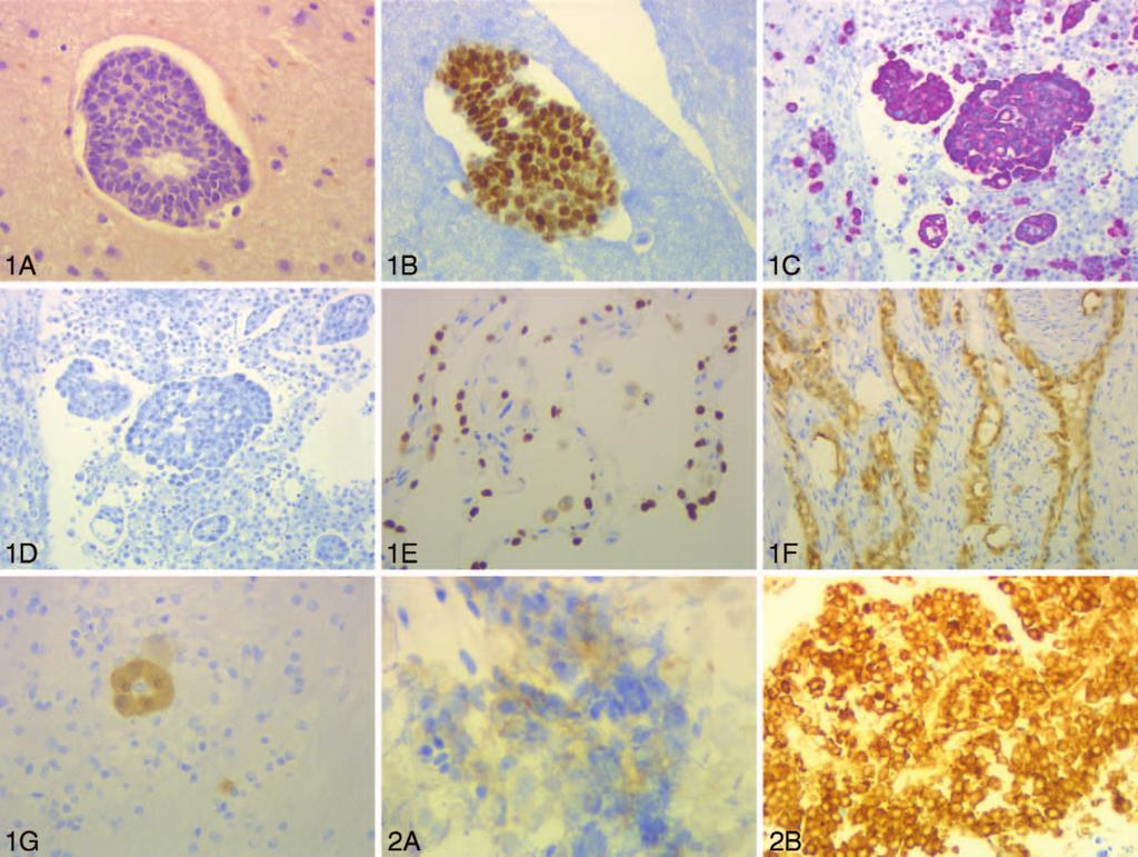 Figure 1. Examples of immunoperoxidase (IP) staining of effusions. A, Adenocarcinoma of breast with negative mucicarmine stain in an ascitic fluid (original magnification 200).