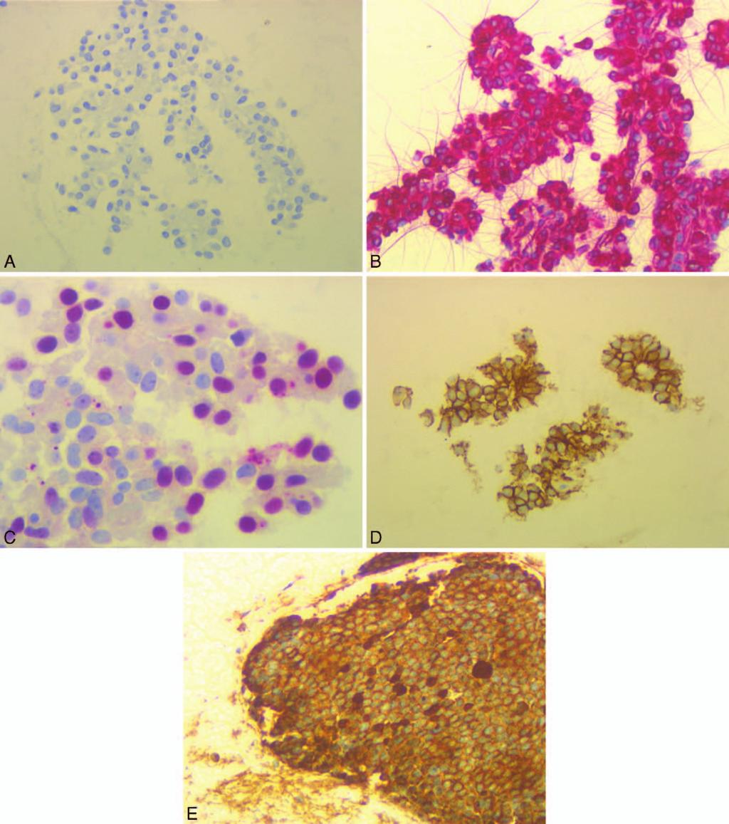 Figure 3. Immunoperoxidase stain examples of pancreas that can be helpful in tumor type differentiation. A, Negative AE1/AE3 from a pancreatic mass (original magnification 200).