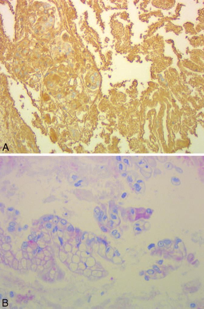 Thyroid FNA for Malignancy Thyroid aspirates are very common to the cytology laboratory; however, most general pathologists will find it difficult to obtain sufficient cellularity from FNA to make a