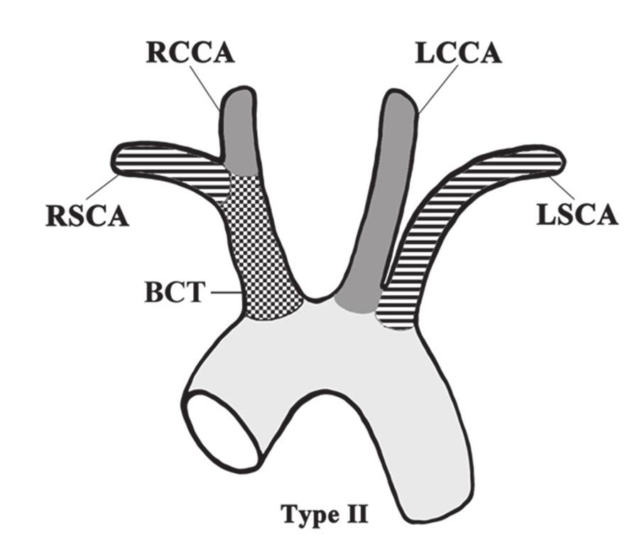 Figure 3. A multislice computed tomographic image of type IIIa. The left common carotid artery (LCCA) shares a origin site with the brachiocephalic trunk (BCT). Note the left subclavian artery (LSCA).