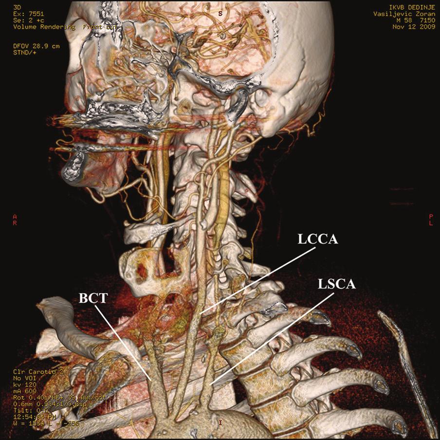 Type IV comprised the aortic origin of both carotid arteries (the RCCA and LCCA) and the subclavian arteries (RSCA and LSCA). This 4-vessel pattern was present in 7 patients, i.e. in 5 with a left aortic arch (Fig.