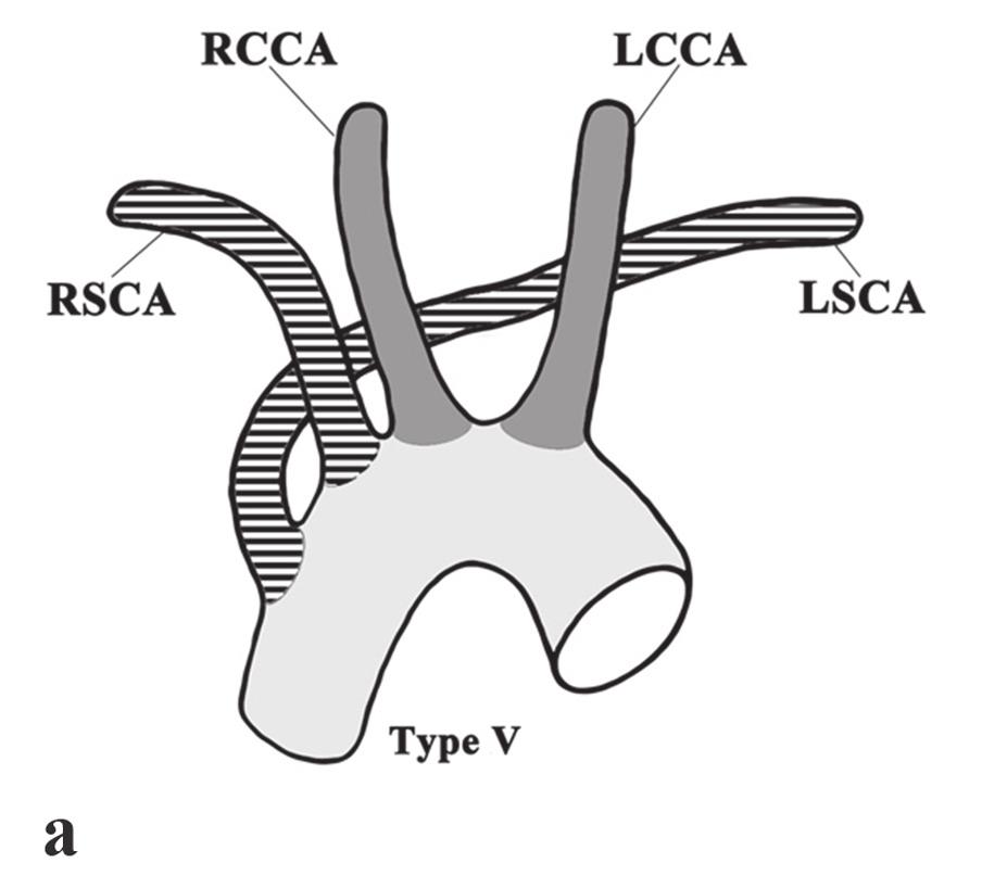 arch of the aorta (B); LSCA left subclavian artery; LCCA and RCCA left and right common carotid arteries. Figure 6. A drawing (A) and a multislice computed tomographic image (B) of type Vb.
