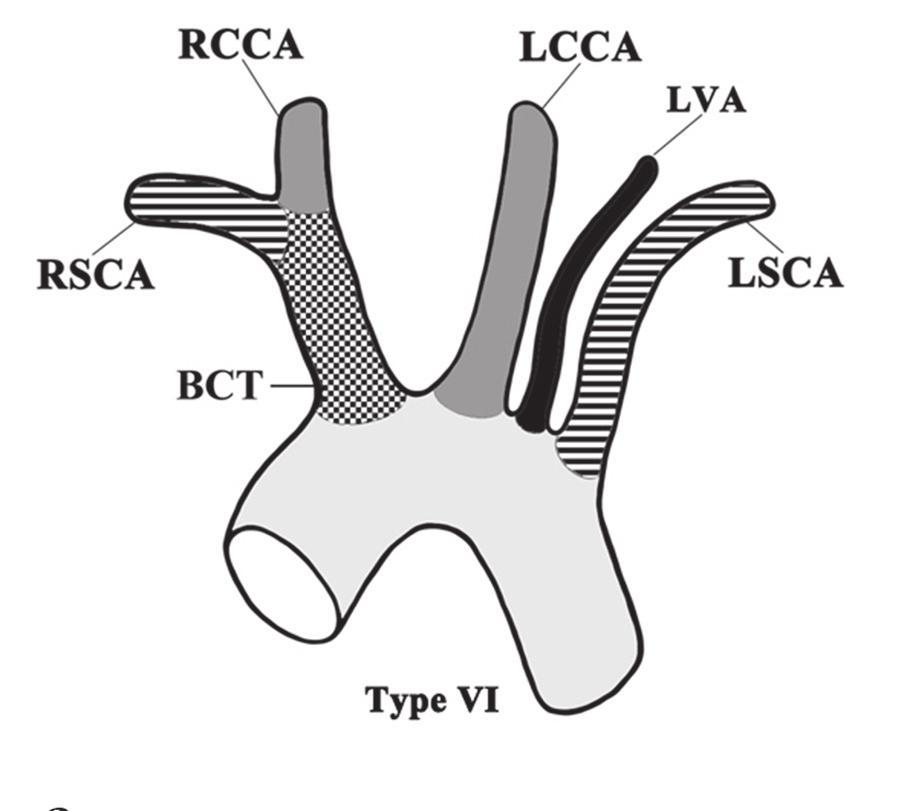 B Figure 7. A drawing (A) and an anterior multislice computed tomographic angiogram (B) presenting type VIa, i.e. the left vertebral artery (LVA) arising from the aortic arch just proximal to the left subclavian artery (LSCA); rest abbreviations as in Table 2.