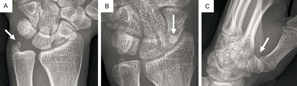 Figure 2. The posteroanterior X-ray films show the sesamoid bones at the ulnar styloid (A), the scaphoid (B) and the base of the first metacarpal (C). Figure 3.