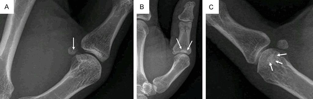 For Type I, there were two ossification centers with one straight fusion line seen on the sesamoid bones (A); for type II, there were two ossification centers with one curve fusion line (B); and for