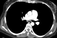 Pulmonary Angiogram CT Pulmonary