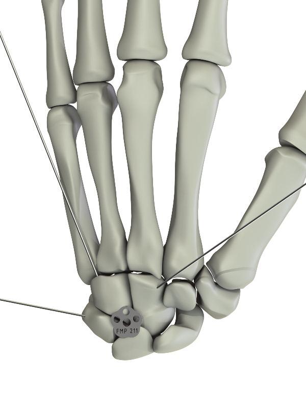 nes to be fused. b. The Mediocarpal Reamer (FIS 204) is available in one size that creates the appropriate recess for either size of the Flower Four Corner Fusion Plate.