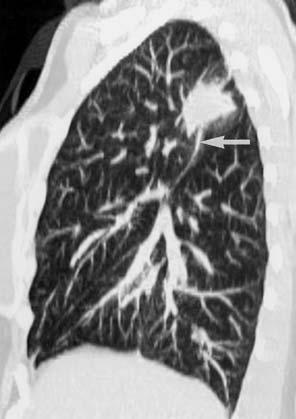 . Frontl chest rdiogrph shows nodule in right upper loe (rrow).