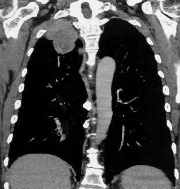 Stging of Lung Cncer with MDCT 209 Fig. 14.4. Apicl lung tumor. Coronl () nd sgittl () multiplnr reformtion CT imges demonstrte right pi cl lung mss.