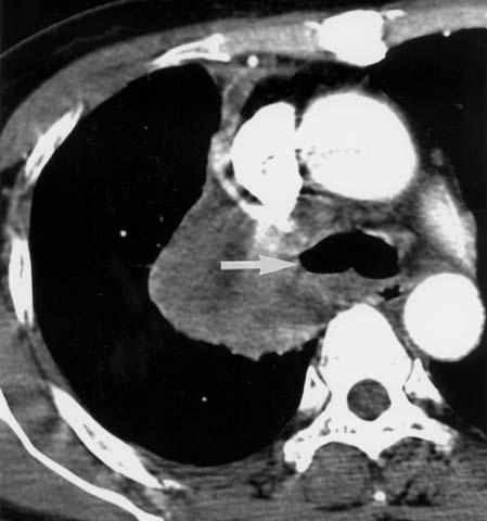 Stging of Lung Cncer with MDCT 211 Fig. 14.8. Invsion of left trium.. Axil CT imge shows cen trl lung cncer resulting in ostruction of right upper loe ronchus (rrow).