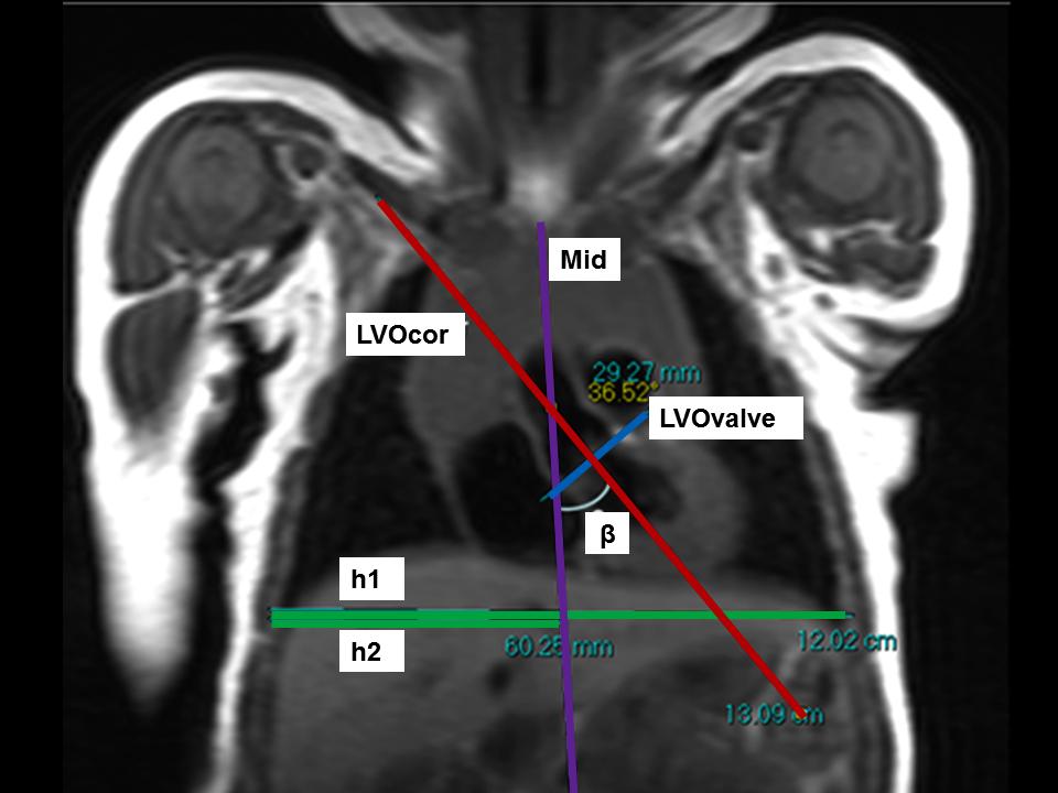Figure 2. Example of a coronal image for analysis of the anatomical position of the left ventricular outflow area Figure 4.