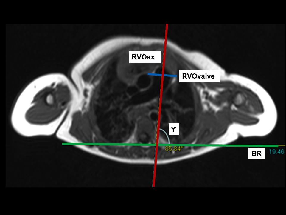 A line was placed through the pulmonary valve annulus (RVOvalve, blue line) with a line perpendicular to represent the right ventricular outflow area on the axial images (RVOax, red line).