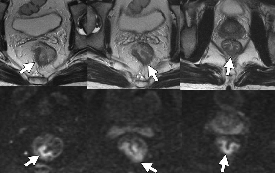 Figure 1 Figure 1: Areas of rectal cancer tissue (arrows) on T2-weighted MR images (top row) correspond to highsignal-intensity areas (arrows) on DW images (bottom row) in a 53-year-old male patient