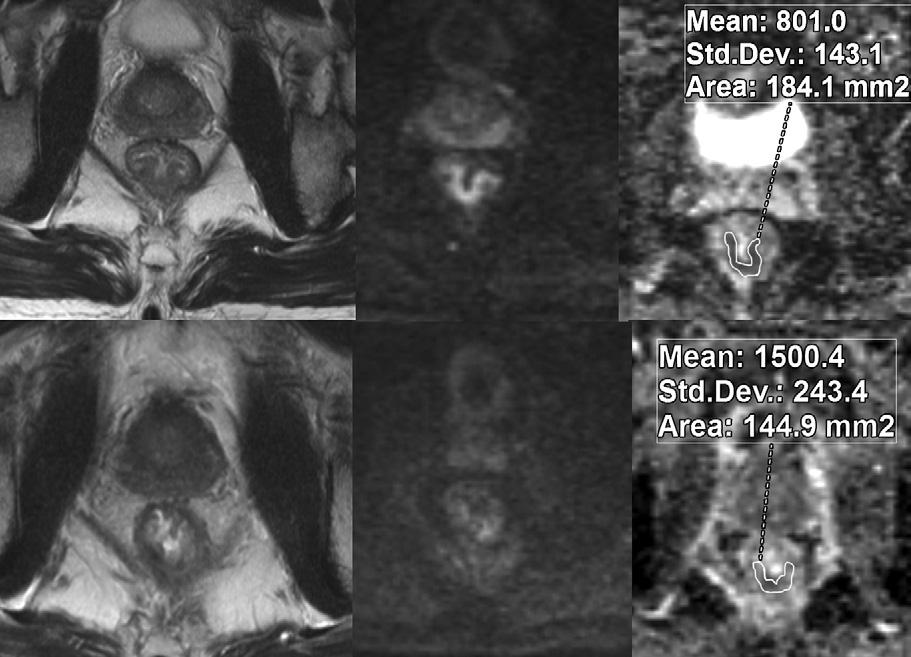 ) Figure 2 Figure 2: Pre- and post-crt T2-weighted (left column), pre- and post-crt DW (middle column), and preand post-crt ADC (right column) image sets of rectal cancer in a 53-year-old male