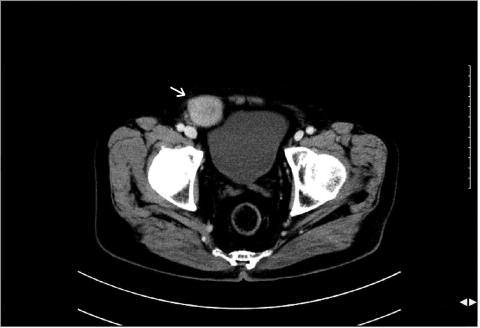 A B C FIGURE 1: Pelvic computed tomography images of an 80-year-old man with a 2-week history of a firm mass in the right inguinal region accompanied by mild, vague pain.
