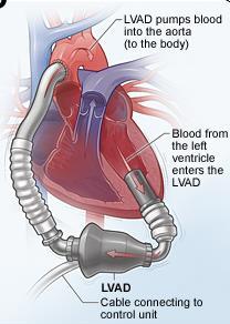 LVAD Basics An LVAD is preload dependent; that mean there needs to be enough blood coming to the LVAD.