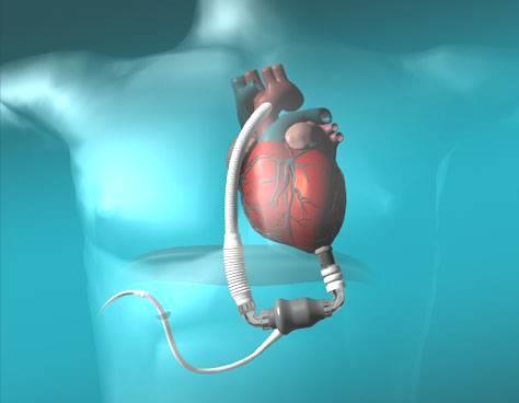 Left Ventricular Assist Device An LVAD is a pump that is connected to the left ventricular at, or near the
