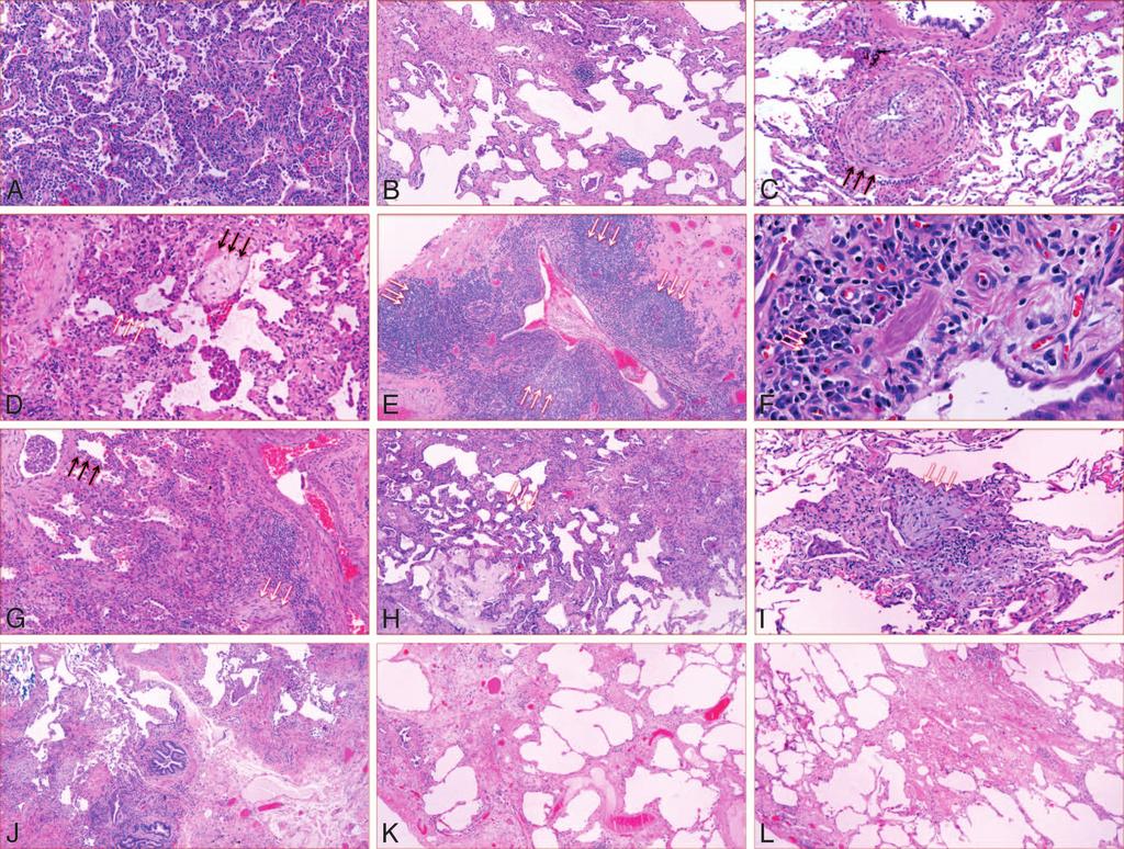 Figure 3. Histopathologic features of samples from patients with idiopathic interstitial pneumonia. A, Cellular nonspecific interstitial pneumonia (NSIP).