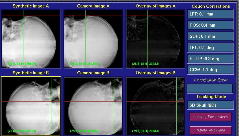 CRANIAL TRACKING On treatment, the dynamic tracking system periodically obtains two orthogonal x-ray images of the patient and compares them with DRRs from the treatment planning.