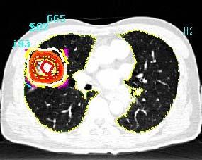 Spiral Breath-hold hold Treatment Planning CT Planning