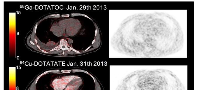 FIGURE 1. Fused PET/CT scans to the left and PET only to the right.