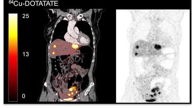 FIGURE 2. Corresponding PET/CT (left) or PET (right) scans of a patient with intestinal NET and multiple metastases.