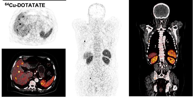 FIGURE 3. Corresponding 68 Ga DOTATOC and 64 Cu DOTATATE PET/CT or PET scans of a patient with intestinal NET and multiple metastases. CT images fused with 64 Cu DOTATATE are contrast enhanced.