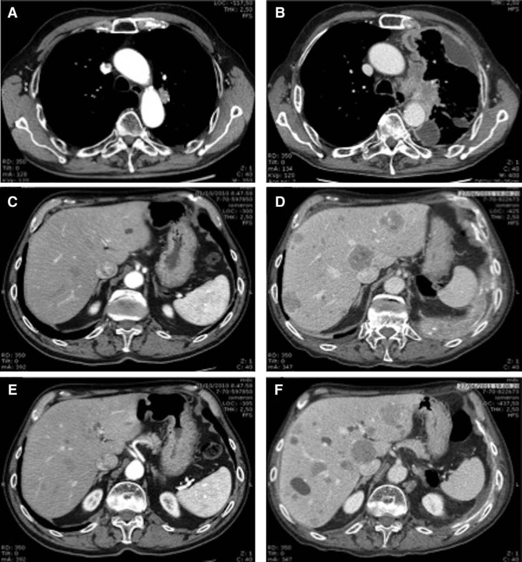 Sollini et al. Journal of Thoracic Oncology Volume 8, Number 8, August 2013 FIGURE 4. Comparison of baseline (A, C, and E) and end-treatment (B, D, and F) contrast-enhanced CT scans in patient no. 2. End-treatment CT scan was performed 48 days after peptide receptor radionuclide therapy.