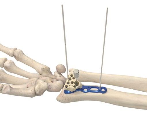 Make a longitudinal incision approximately six centimeters in length just radial to the FCR tendon to protect against injury to the palmar cutaneous branch of the median nerve.