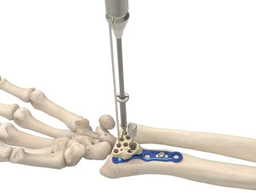 Acu-Loc Volar Plate Technique [continued] 5 Distal Screw Selection There are three types of 2.