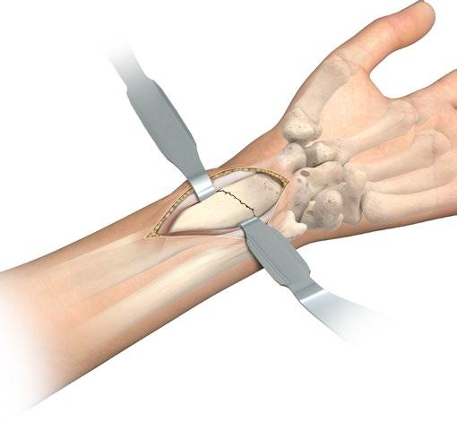 Make a longitudinal incision approximately six centimeters in length just radial to the FCR tendon to protect against potential injury to the palmar cutaneous branch of the median nerve.