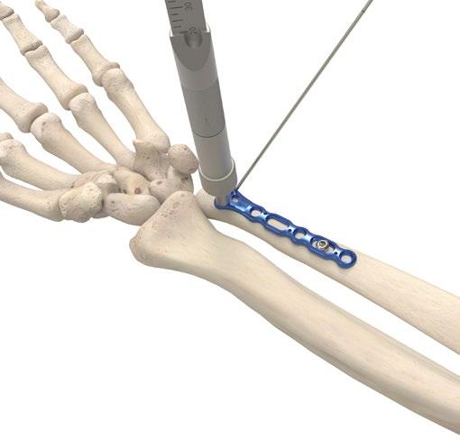 Acu-Loc VDU Plate Technique [continued] 5 Distal Screw Selection There are three types of 2.