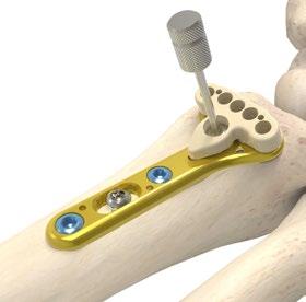 fractures Corrective osteotomy Flat