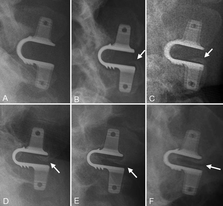 Heterotopic ossification after dynamic interspinous fixation Fig. 2. Radiographs of 6 patients, lateral views. A: No HO. B F: Various forms of HO (arrows) in the interspinous space.