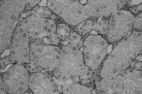 Splitting and multilayering of peritubular capillary basement membranes by electron microscopy holds promise as a relatively specific marker for chronic rejection [14,15].