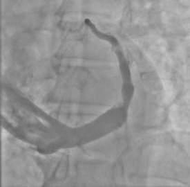 Reducer Procedure Treatment by narrowing coronary sinus based on a surgical procedure performed in 1960 s (Beck Procedure) Beck Procedure reported excellent results but is no longer performed due to