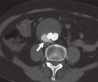 In the past, most investigators discussed the use of imaging-based parameters for the prediction of persistent type II endoleak in terms of assessing preoperative CT findings only.