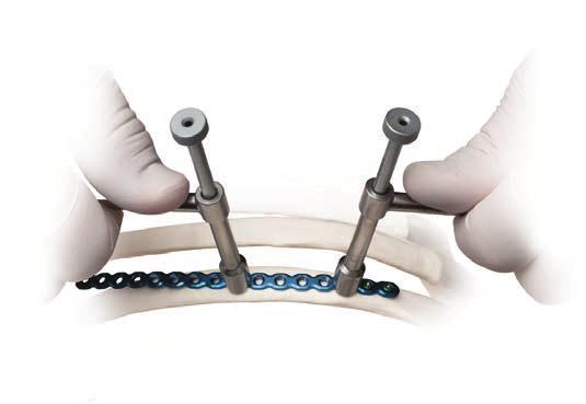 torsional - eliminating the need to remove the implant from the surgical field.