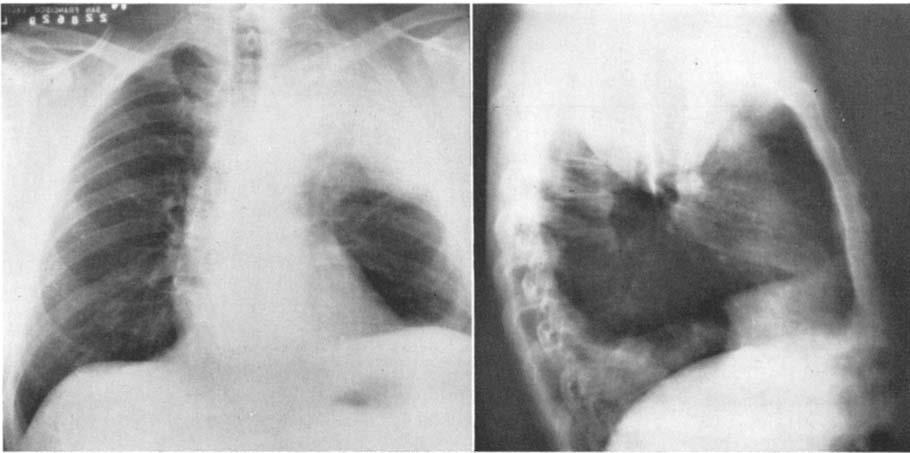 COHN AND HALL A FIG. 1. P-A (A) and lateral (B) x-rays of the chest taken on admission showing an extensive neoplastic mass in the left upper lobe and a small left pleural eflusion.