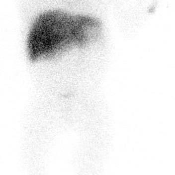 A hepatobiliary scintigraphy was performed and showed no filling of the intra or extrahepatic bile ducts, nor excretion of the contrast fluid to the intestine up to 6 hours after injection (Fig. 2).