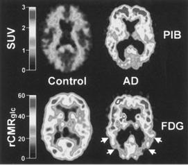 Research Suggests Amyloid Protein is Central to AD Amyloid Imaging Shows Amyloid in the Brain in AD