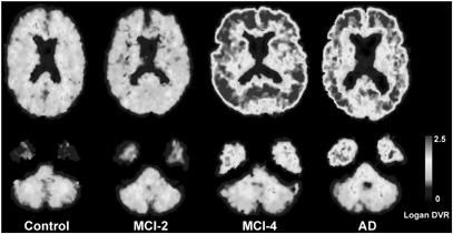 Amyloid Imaging Shows Amyloid in Some MCI and Some Normal Elderly Other Biomarkers Identify Early AD