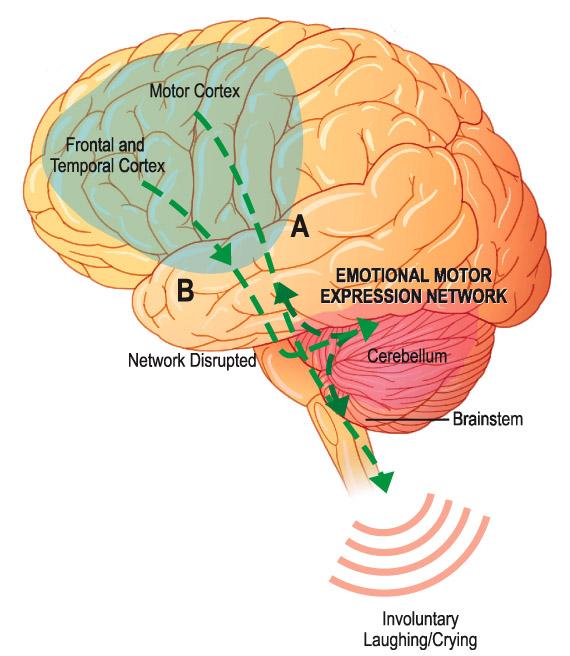 Putative gate control of emotional expression Somatosensory cortex BA 5, 5, BA BA 40 Normal BA 40 7 7 Somatosensory cortex PBA Excitatory Inhibitory Excitatory Inhibitory 17 Haiman G et al.