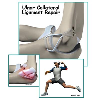Introduction The doctors call it a UCLR ulnar collateral ligament reconstruction.