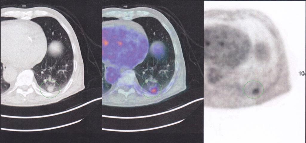 Annals of Translational Medicine, Vol 4, No 22 November 2016 Page 3 of 5 Figure 3 Tumor nodule in left lower lobe. Diameter 1.8 cm in computed tomography (CT) scan.