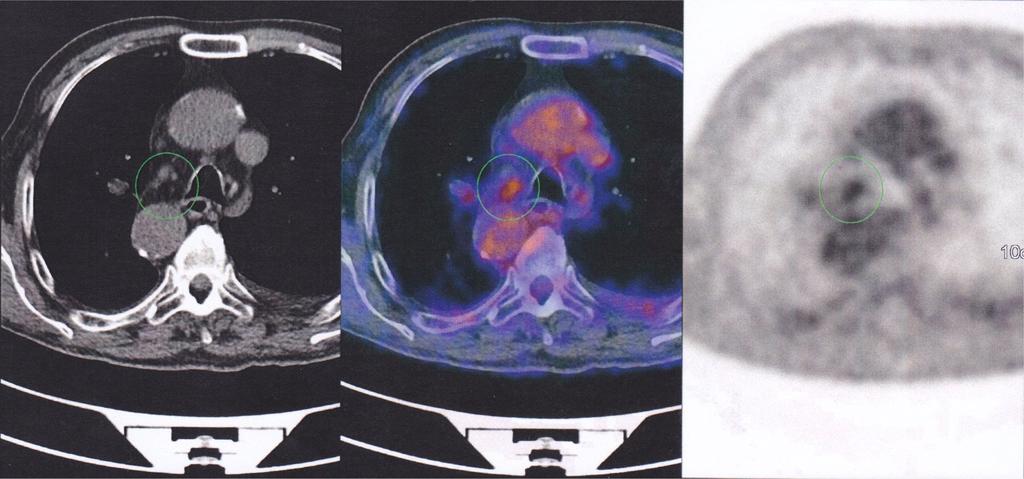 A LN biopsy with uniportal-video-assisted thoracoscopic surgery (VATS) was performed. Mirror image anatomy is detected with ascending, descending aorta and superior vena cava.