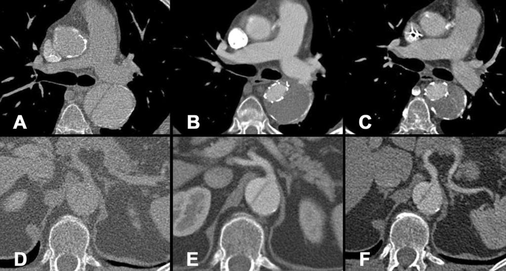 Ann Thorac Surg PACINI ET AL 2011;92:1663 70 FET FOR CHRONIC THORACIC AORTIC DISSECTION Fig 1.