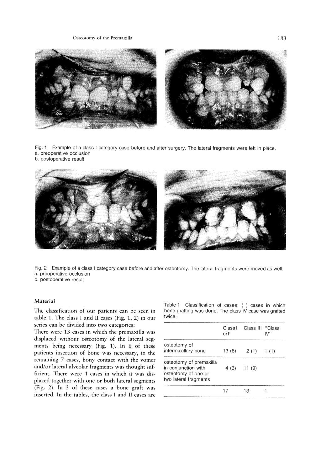 Osteotorny of the Premaxilla ] 83 Fig, 1 Example of a class I category case before and after surgery. The lateral fragments were left in place. Fig. 2 Example of a class I category case before and after osteotomy.