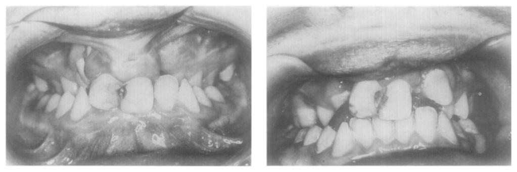 There were 4 cases in which it was displaced together with one or both lateral segments (Fig. 2). In 3 of these cases a bone graft was inserted.