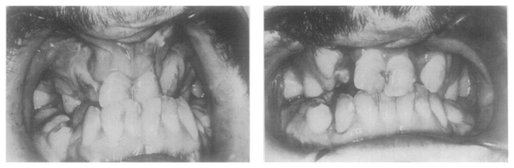 With "class IV" we want to indicate the case depicted in Fig. 5, an extreme case in which the two incisors were situated at a very high level.